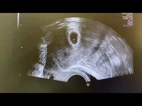 انتقال جنین تحت بیهوشی