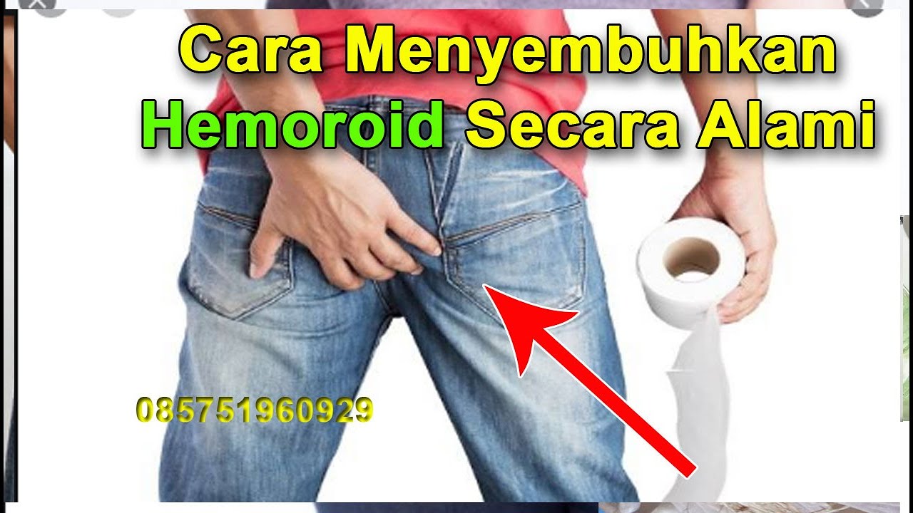 Cara Menyembuhkan Hemoroid Secara Alami 