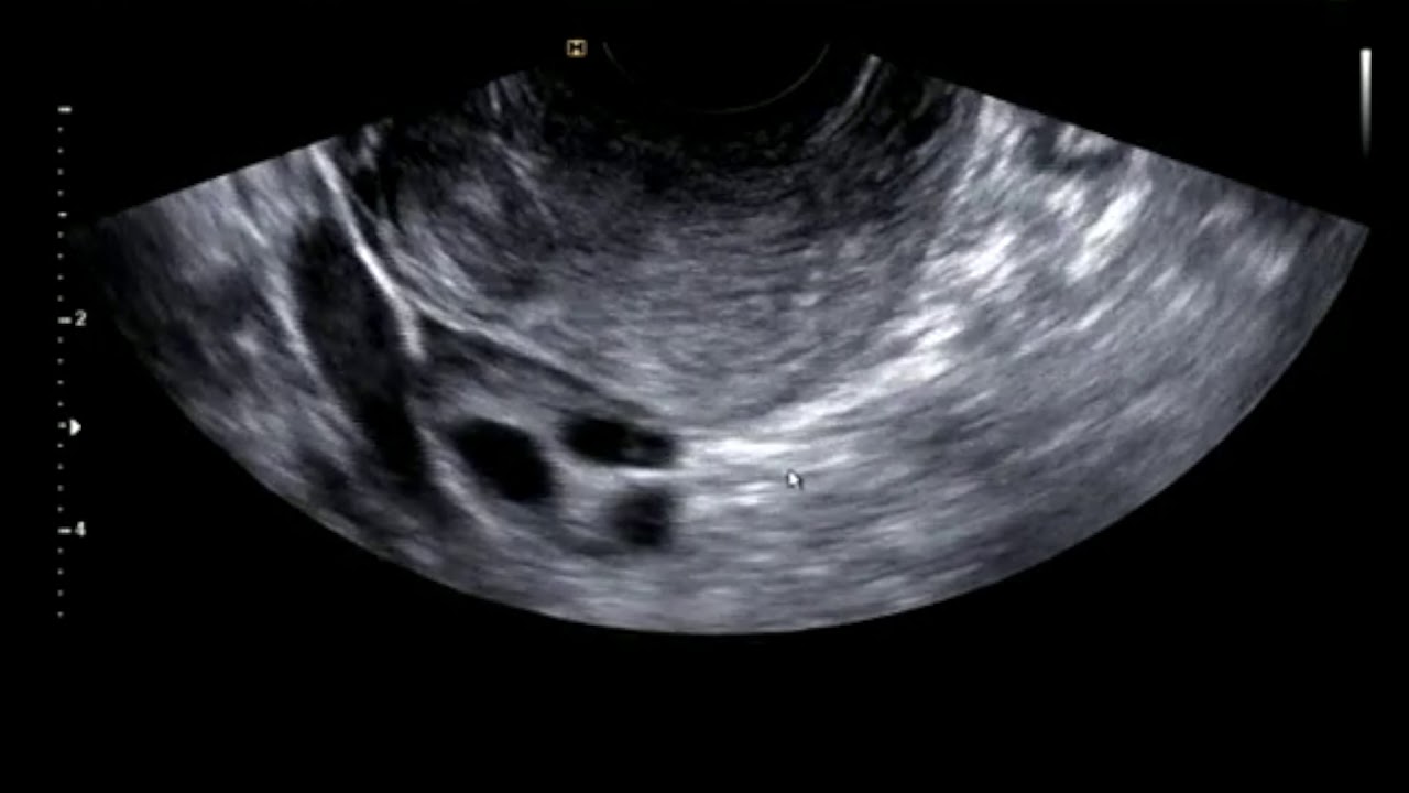 자궁 근종의 초음파 동영상