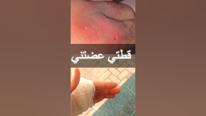 إحذروا⚠️عضة القطط قد تكون  بعض الأحيان قاتلة | cat bite
