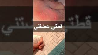 إحذروا⚠️عضة القطط قد تكون  بعض الأحيان قاتلة | cat bite