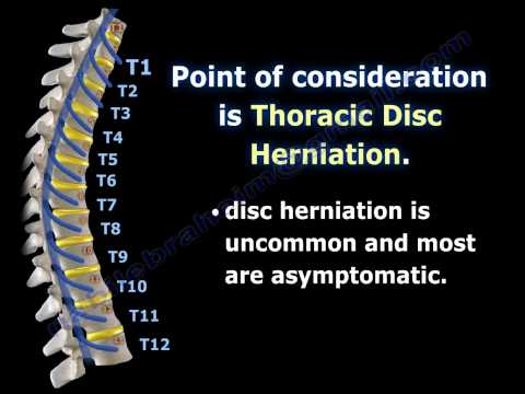 Video Icd 10 Scoliosis