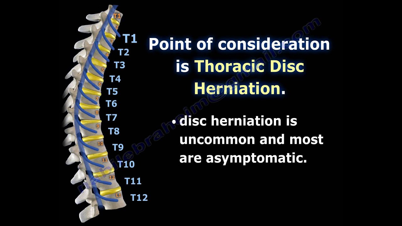 Thoracic Disc Herniation Everything You Need To Know Dr Nabil Ebraheim Youtube