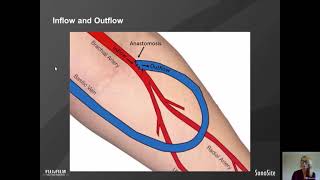 Webinar: Dialysis Vascular Access Flow Volume