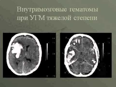 ВМА острая ЧМТ КТ классификация ушибов головного мозга ВМА острая ЧМТ КТ классификация ушибов головного мозга