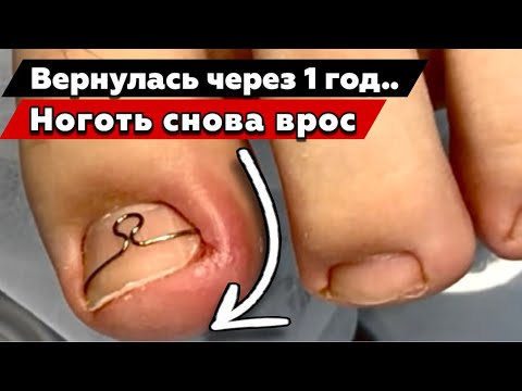 Вросший ноготь 12 лет. Ingrown toenail in 12 years 