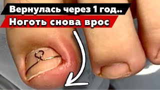 Вросший ноготь 12 лет. Ingrown toenail in 12 years 