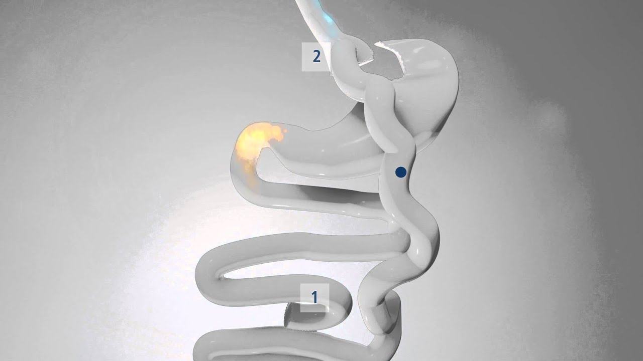 BYPASS GASTRIQUE EN Y