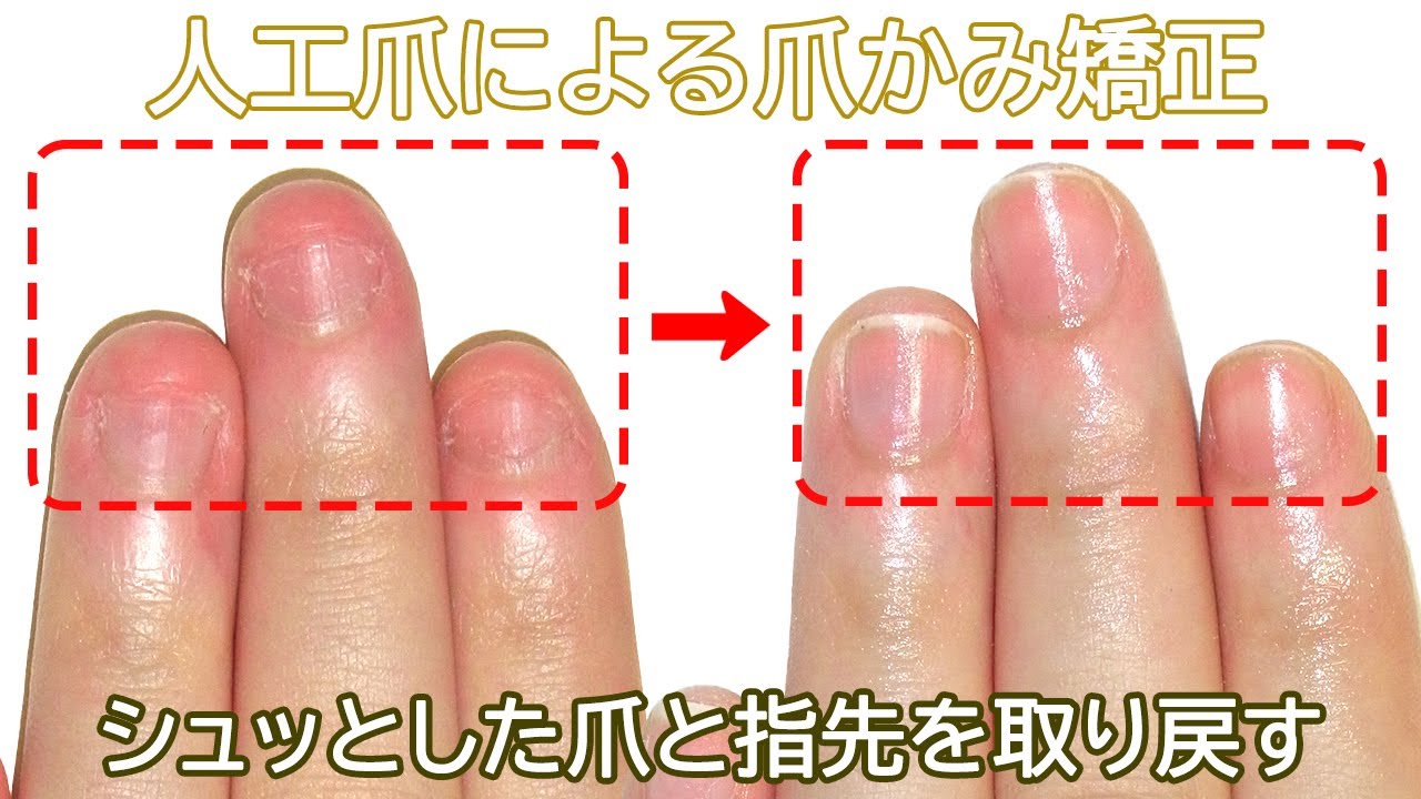 爪 噛む 癖