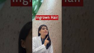 Ingrown Hair Removal | Ingrown Hair | Strawberry Legs #shorts