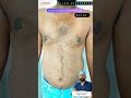 Gynecomastia Surgery Result | Delhi Mumbai Kolkata Surat Ahmedabad Jaipur Kota Nagpur Raipur Bhopal