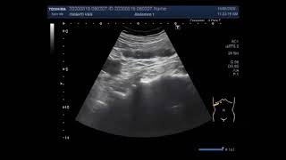 Gallbladder bladder polyps and ureteric stone