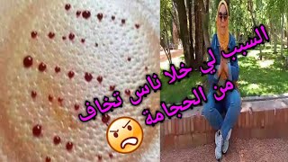 التشريط الكبير و كثرة الدم ? من الأسباب لي خلاو الناس إبعدو من الحجامة و يخافو إدروها??