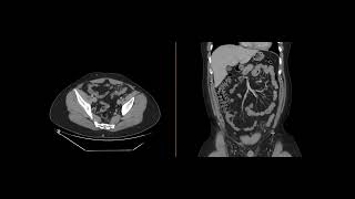 Epiploic Appendagitis