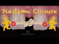 Diastema closure using direct bonding ( front wing technique)