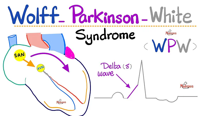 Heart Arrhythmia - Wolff-Parkinson White (WPW) Syndrome - AVRT - Supraventricular Tachycardia - ECG