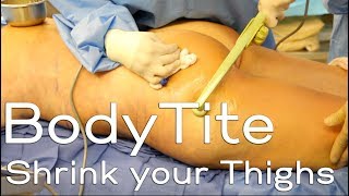 BodyTite to Tighten Skin and Reduce Fat on the Inner and Outer Thighs