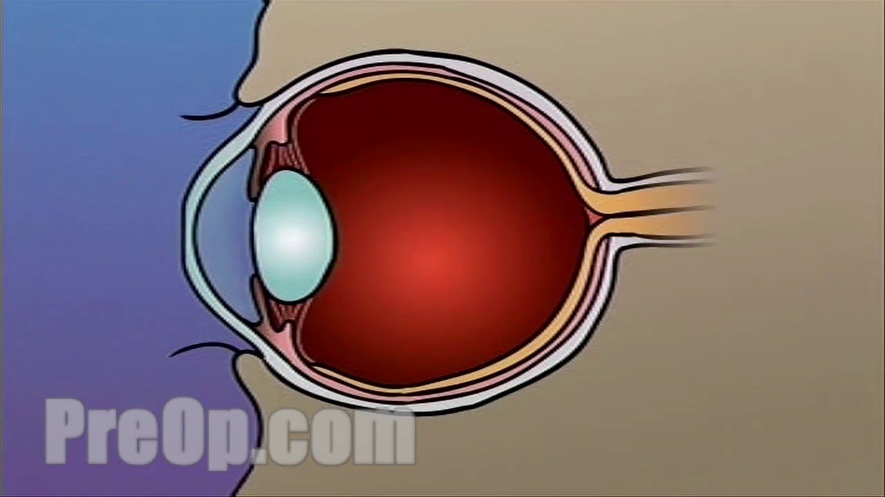 Laser Eye LASIK Surgery PreOp® Patient Engagement and Education YouTube