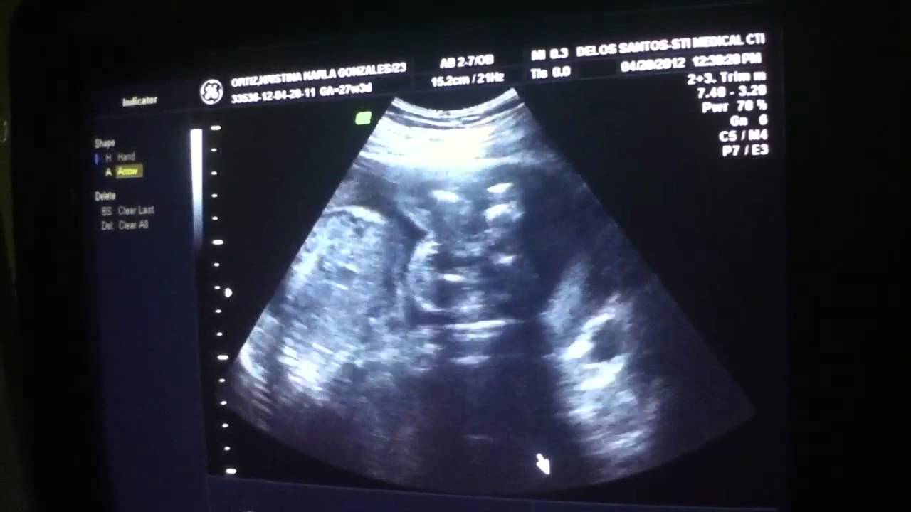 Congenital Anomaly Scan YouTube Congenital Anomaly Scan YouTube