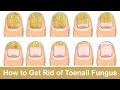 How to Get Rid of Toenail Fungus Fast and Naturally