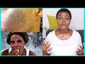 HOW TO REPAIR DAMAGED BLEACHED SKIN | What To Use After Skin Bleaching To Make Your Skin Glow