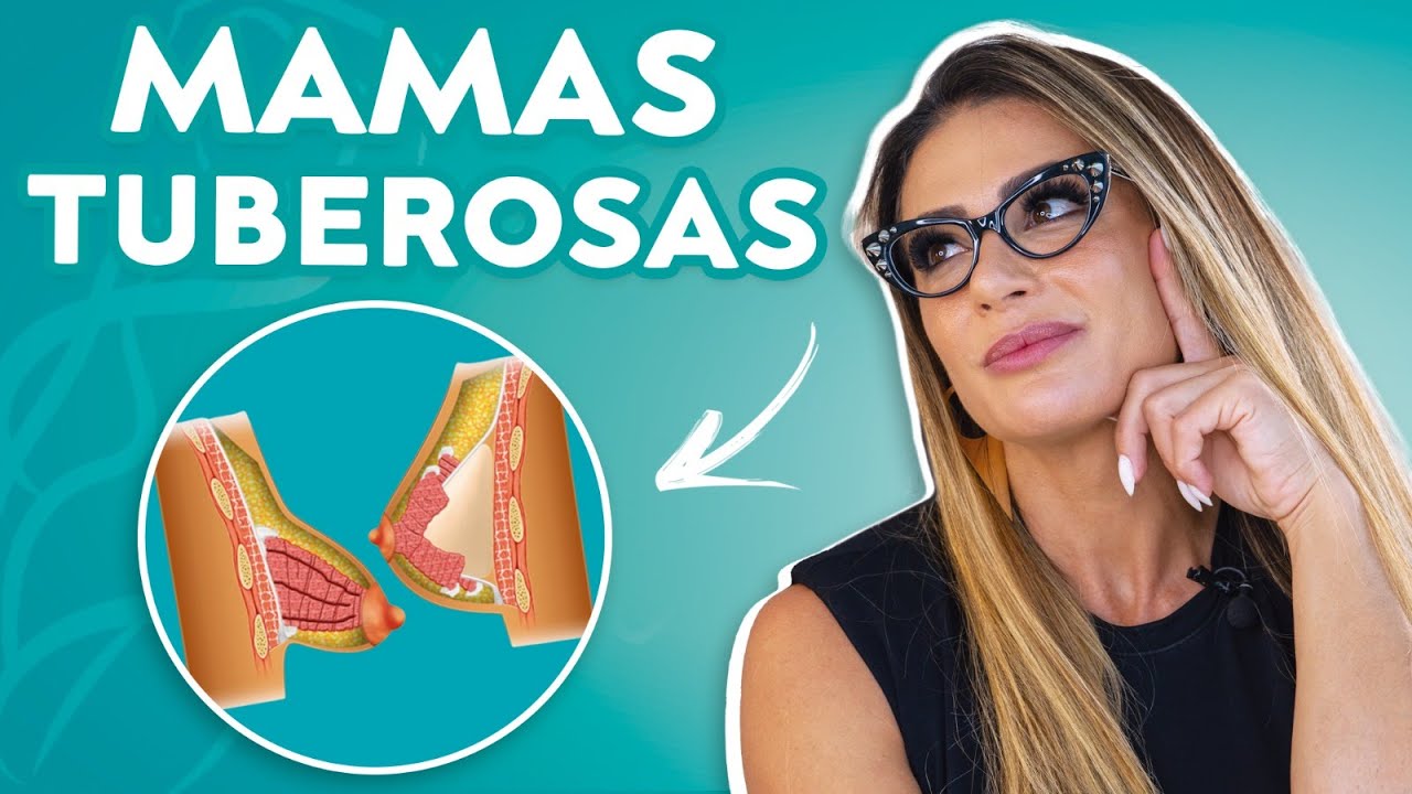 O QUE SÃO AS MAMAS TUBEROSAS?