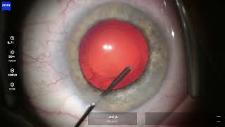 Information OD 2026 08 03 100439 Phaco Update