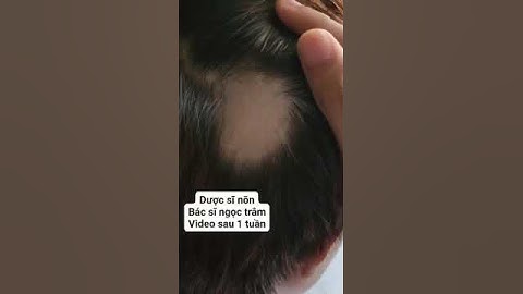 rụng tóc mảng, trụi tóc