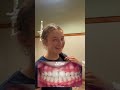 #transformationtuesday Check this bite correction! Midlines corrected, bite opened and overjet fixed