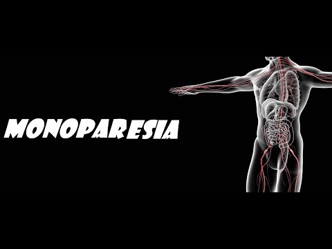 Vídeo: Monoplejia: Qué Es, Causas, Síntomas Y Tratamiento