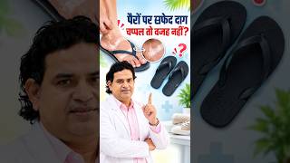 चप्पल की Strap से सफेद दाग क्यों होते हैं? | Plastic & Rubber Footwear Allergy | Dermatologist