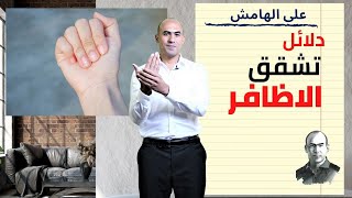 الأظافر وعلامات نقص الفيتامينات والمعادن | على الهامش