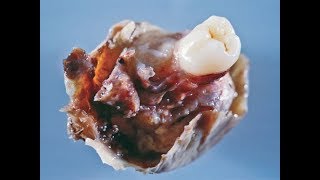 Tumor with teeth and hair, Dermoid Cyst or Teratoma