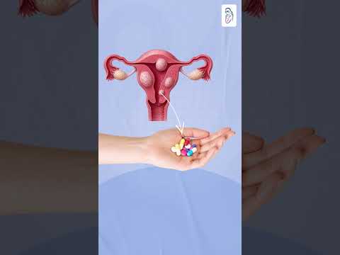 गर्भाशयातील गाठी (Fibroids) म्हणजे कॅन्सर का?  #KaradGynecologist