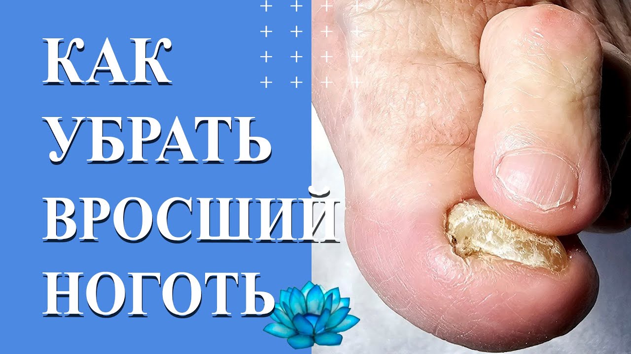 Онихокриптоз. У клиента вросший ноготь на большом пальце ноги. - YouTube
