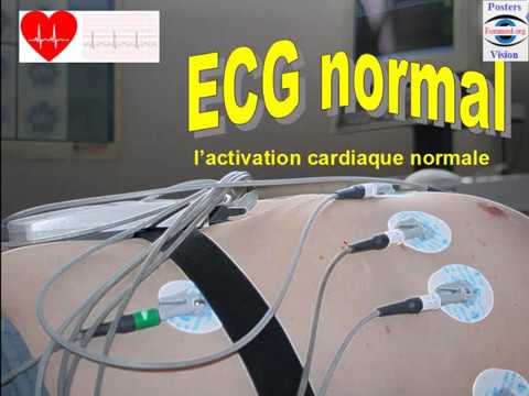 Lecture d'un Ecg cardiaque normal comment placer les electrodes
