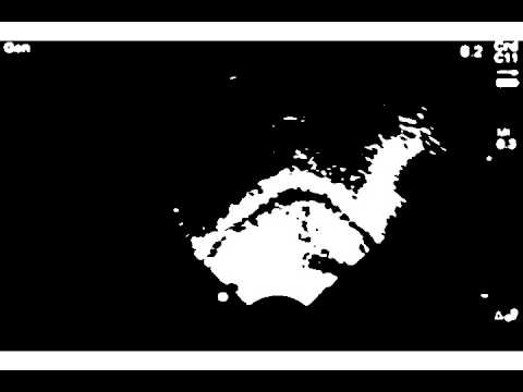 x2 Gaussian blur with Otsu's thresholding for ultrasound images