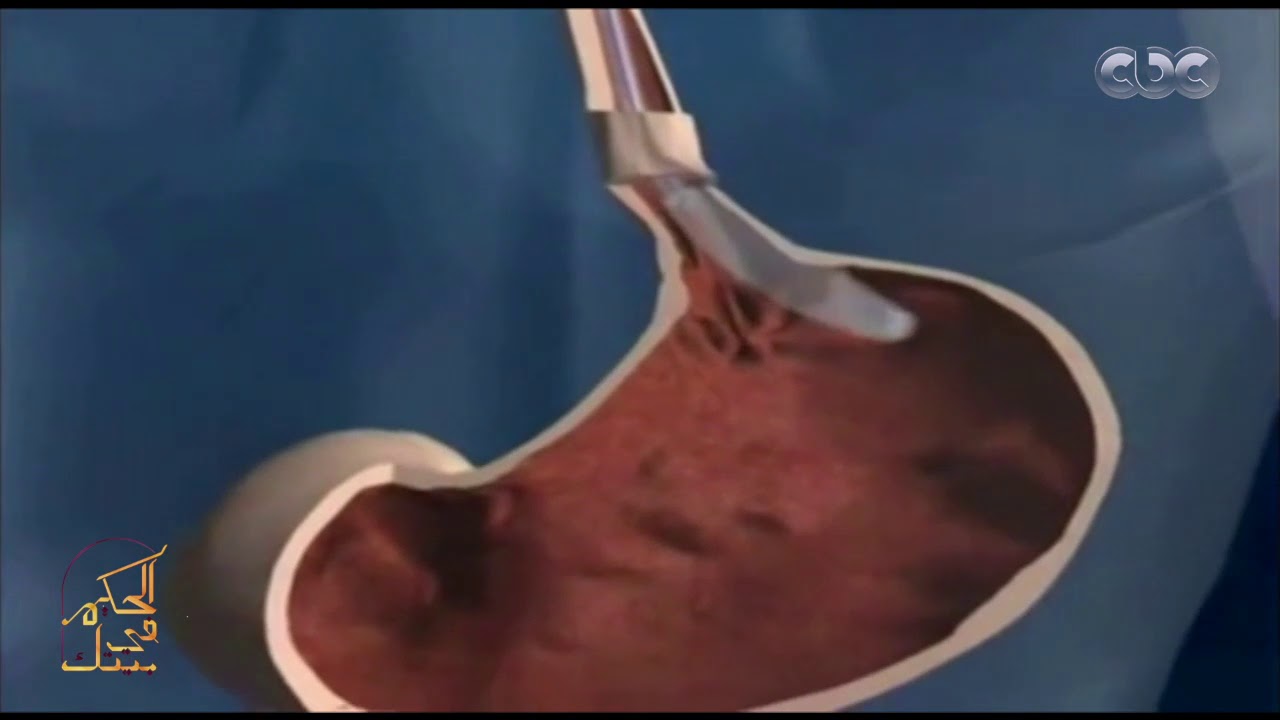 الحكيم في بيتك | ليه الناس بتوافق على عمليات بالون المعدة أكثر من جراحات السمنة التانية؟