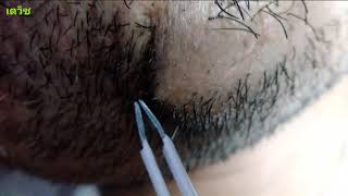 Plucking facial hair ( 拔胡子毛 ) EP.04