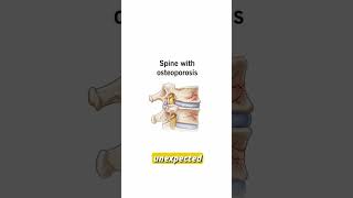Bone Density Scan - Why It Matters