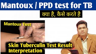 What is Mantoux Test for TB | Procedure and Interpretation Tuberculin Test Result  | PPD Test