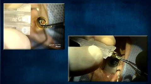 Lens Loading of Single Piece IOL with Standard Forceps