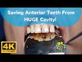 Saving Anterior Teeth From HUGE Cavity!