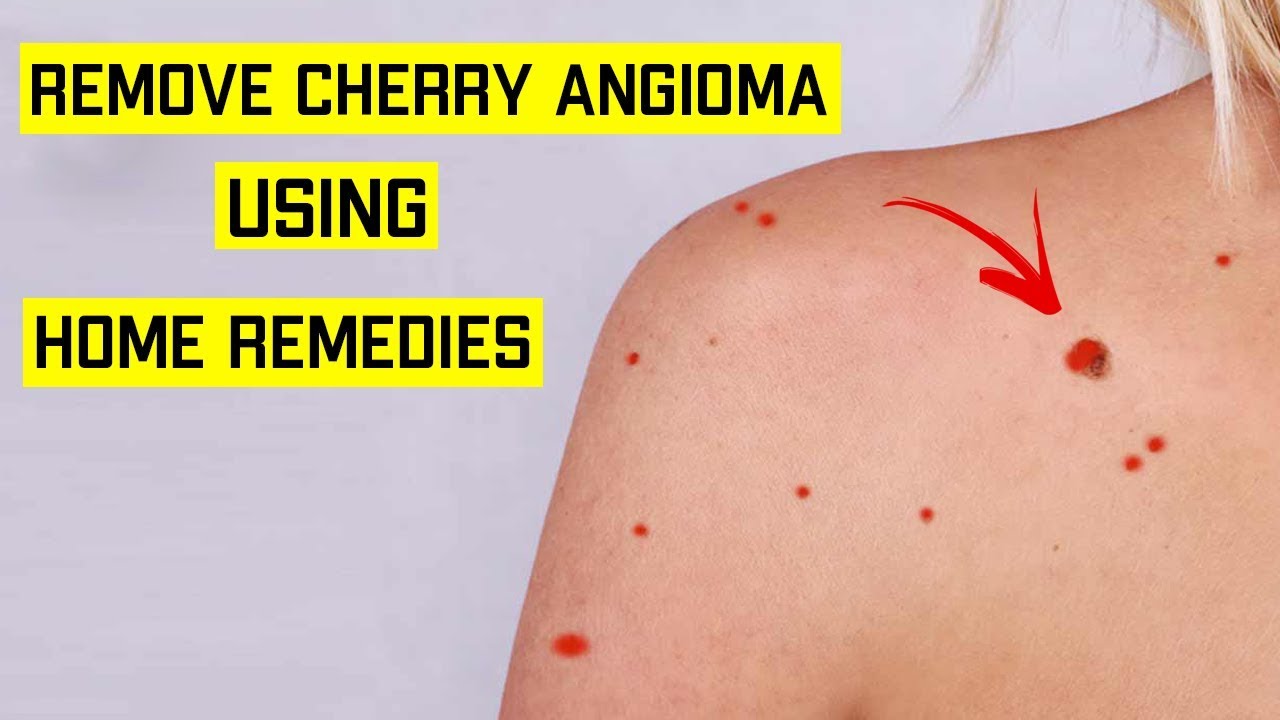 How To Get Rid Of Cherry Angioma Naturally Top 5 Home Remedies For 