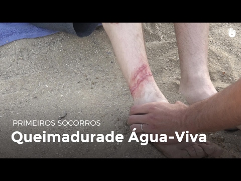 Vídeo: Picada De Medusa: Sintomas, Tratamentos E Muito Mais