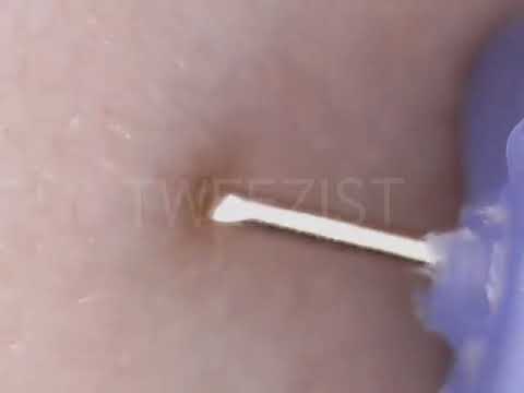Remove Ingrown Hair With Blackhead Youtube