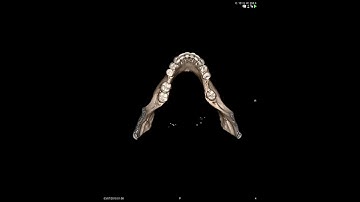Volumetric Rendering CT mandible