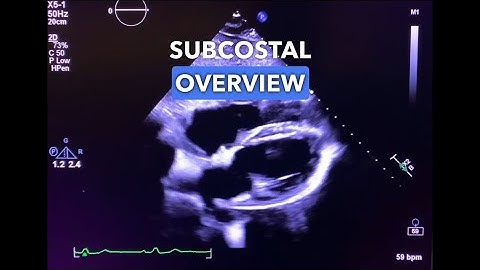 Subcostal View - Echocardiography Education
