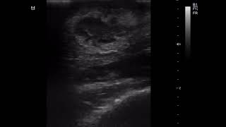 CASE 1016 fascial subdermal  abscess