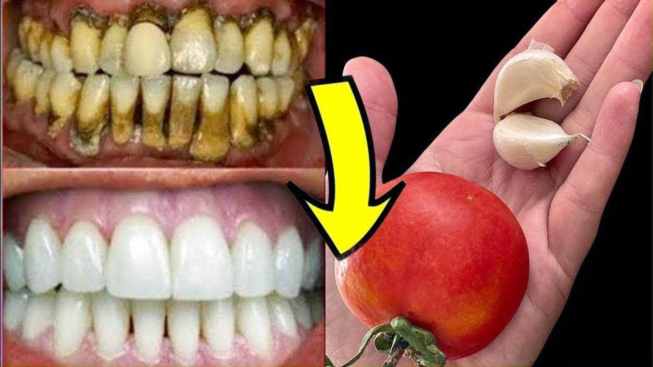 3 Home Remedies for Teeth Whitening Naturally Hacks For Whiter Teeth